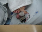 Rose's tiny toes with the IV and oxygen monitor